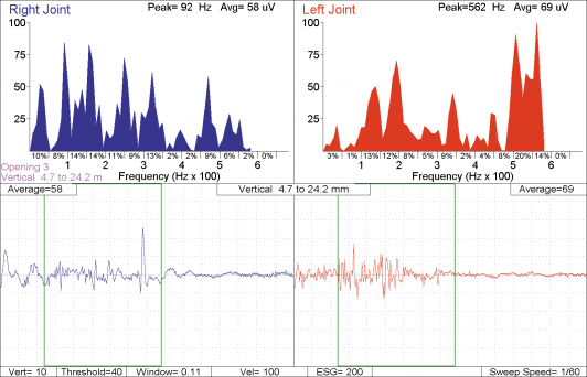Myotronics Sonography graph