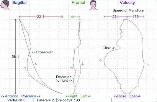 Myotronics Jaw Tracking chart
