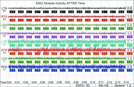 Myotronics Electromyography graph