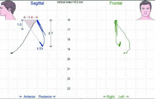 Myotronics Jaw Tracking chart