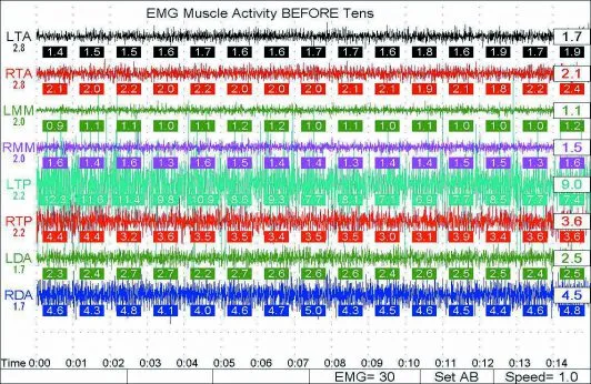 Myotronics Electromyography graph